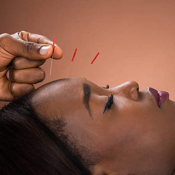 I Tried Acupuncture For The First Time & This Happened