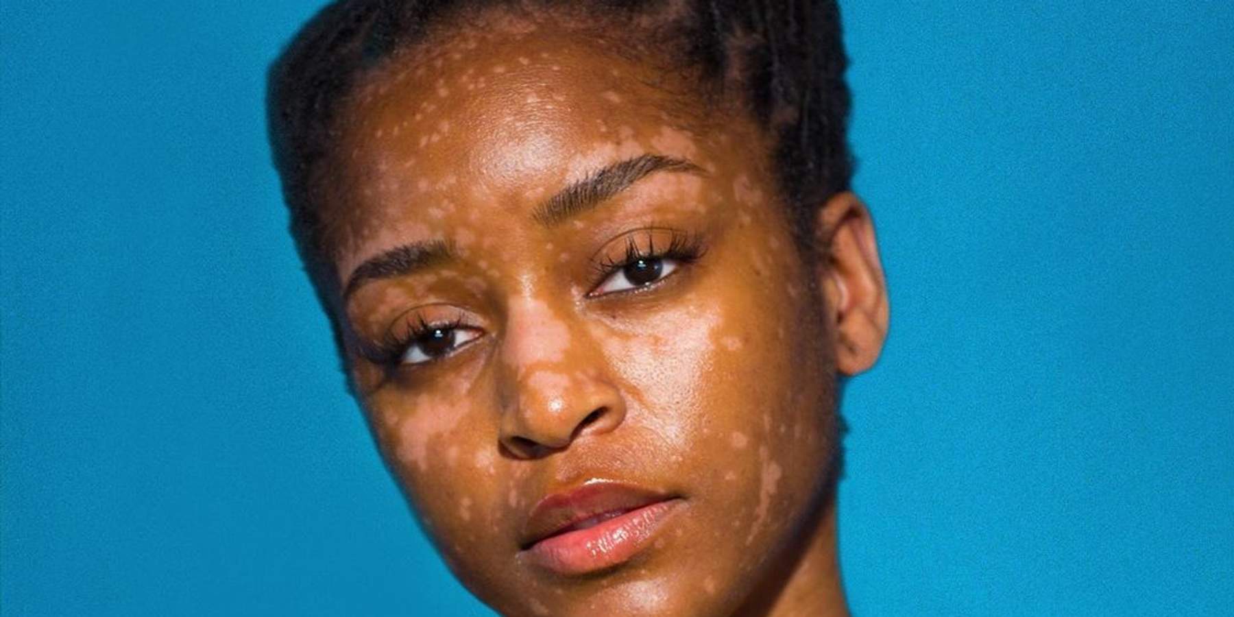 Women With Unique Skin Share How They Learned To Love Their Purpose-Built Beauty