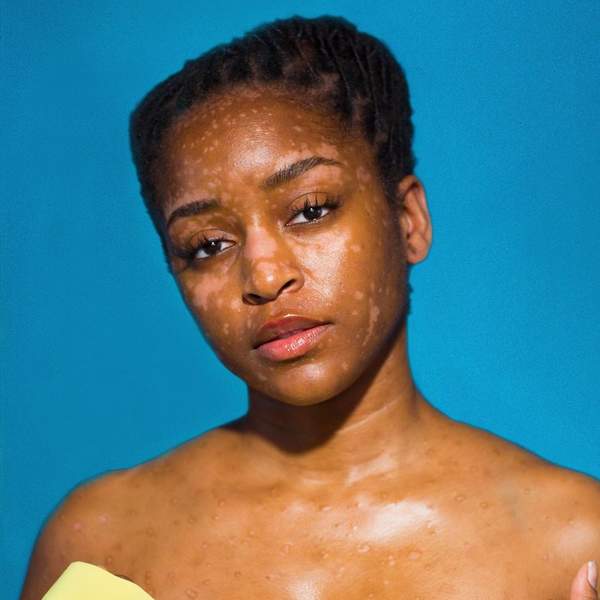 Women With Unique Skin Share How They Learned To Love Their Purpose-Built Beauty