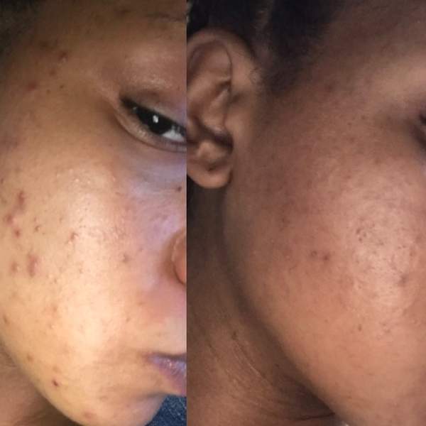 The Skincare Routine That Got My Cystic Acne All The Way Together