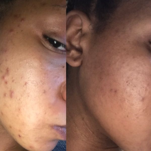 The Skincare Routine That Got My Cystic Acne All The Way Together